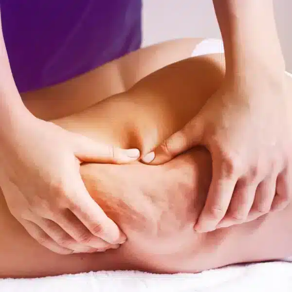 tratamiento para la celulitis