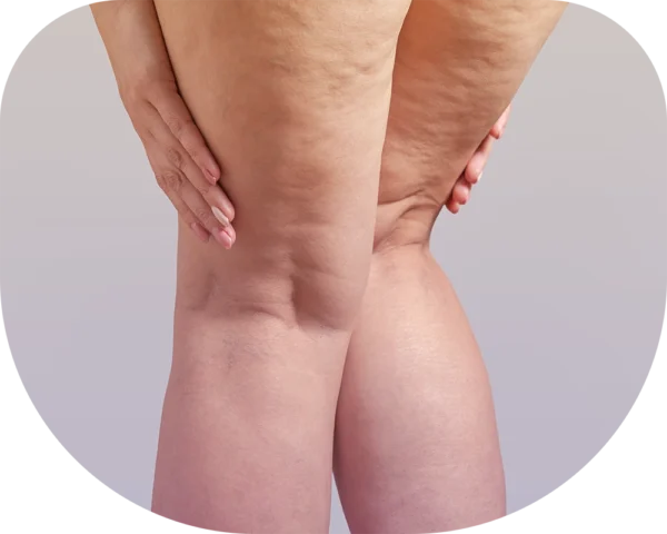 celulitis