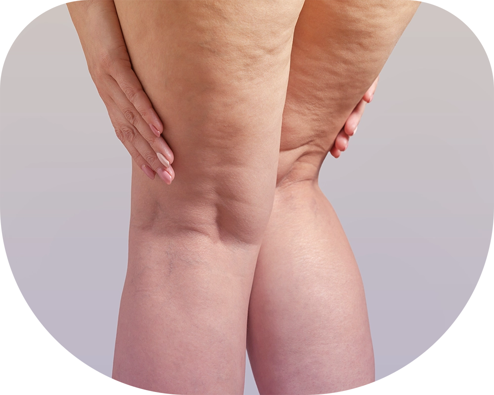 celulitis